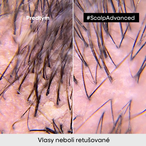 L'Oréal Professionnel Scalp Advanced Anti-Discomfort Dermo regulator šampón na upokojenie pokožky hlavy 500 ml